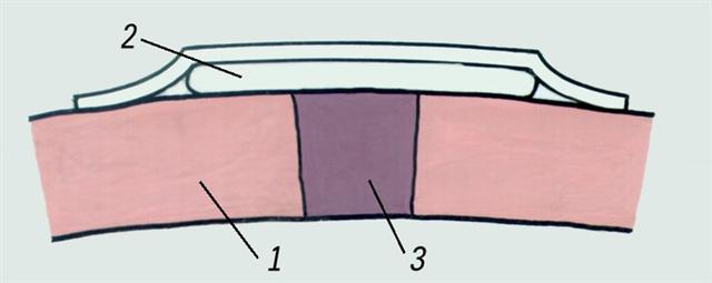 Грудь. Схема герметичной повязки при проникающем ранении