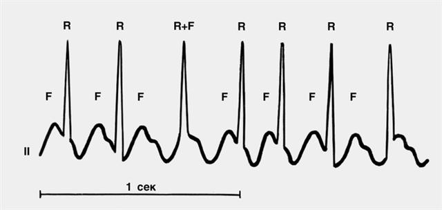 Электрокардиограммы при диссоциированном трепетании предсердий