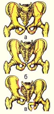 Таз. Схема переломов костей таза