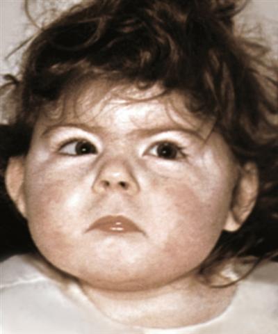 Внешние проявления синдрома де Ланге