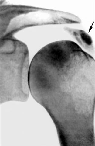 Ретгенограмма плечевого сустава при кальцифицирующем бурсите