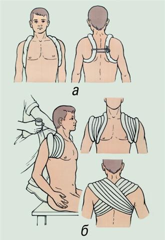 Иммобилизация верхней конечности при переломах ключицы