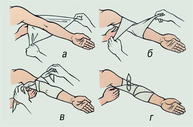 Локтевой сустав. Наложение косыночной повязки