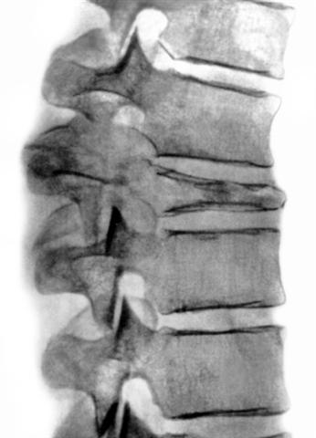Рентгенограмма позвоночника при деструкции тела позвонка опухолевым процессом