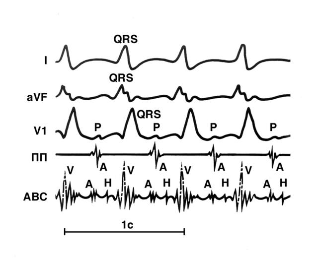 Электрокардиографические кривые при предсердной тахикардии в сочетании с блокадой правой ножки пучка Гиса