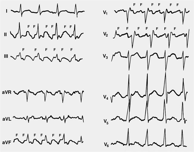 Электрокардиограммы при правильной форме ассоциированного трепетания предсердий