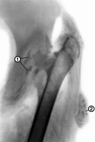 Рентгенограмма левого тазобедренного сустава