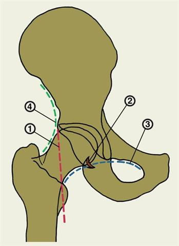 Схема ориентиров нормальных анатомических взаимоотношений в тазобедренном суставе