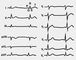 Изображение к статье Электрокардиография