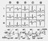 Изображение к статье Электрокардиография